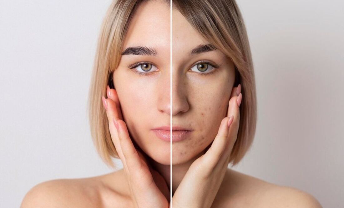 El acné se produce como consecuencia de un taponamiento de los folículos de la piel. Fuente: Freepik.