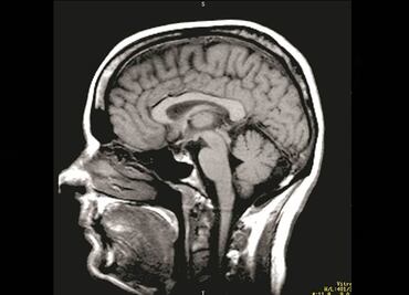 Paciente ruso podría someterse al primer trasplante de cabeza