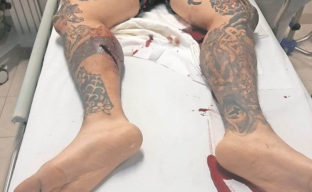 Joel recibió tres disparos en las piernas y en un glúteo. Foto: Especial