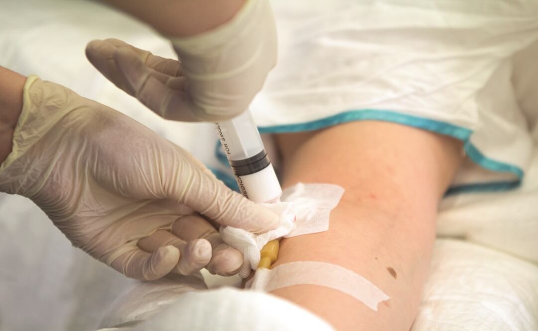 Anesthesiologist make an injection of a medicine intravenously – Photo: Vitality Zubritsky/EL UNIVERSAL