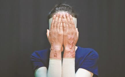 PAN propone penalizar con hasta 26 años de cárcel ataques ácidos contra mujeres