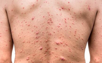 Suman 12 casos positivos de viruela del mono en Sinaloa