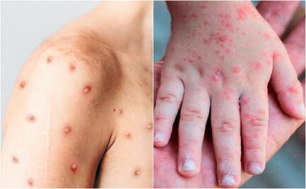 ¿Quiénes son más vulnerables frente a una infección por viruela del mono?