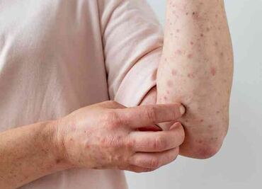 Reportan dos casos nuevos de viruela del mono en Morelos