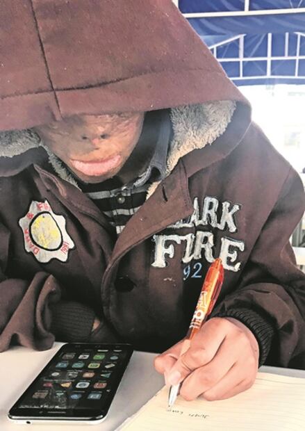 Juanito, 13 años luchando para sanar sus quemaduras