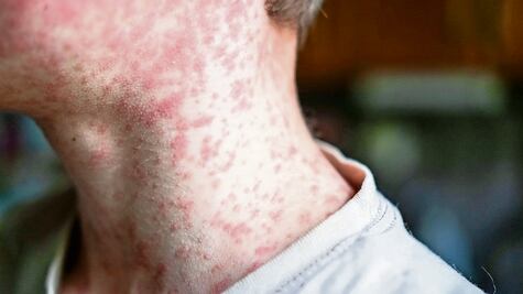 Más casos de sarampión