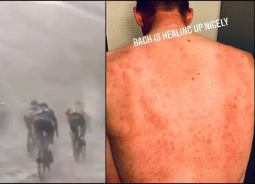 Ciclista muestra como queda su espalda tras rodar en granizada