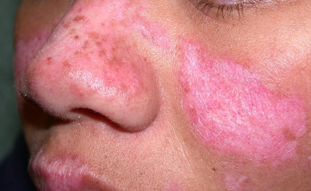 Ven carencias en el país para tratar lupus