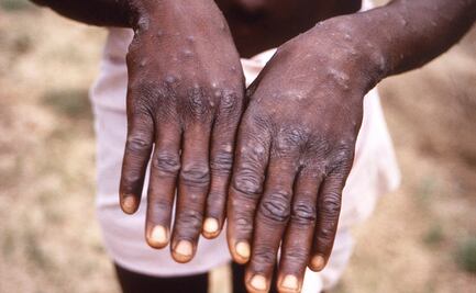 EU tiene registro de casi 3 mil casos de viruela del mono