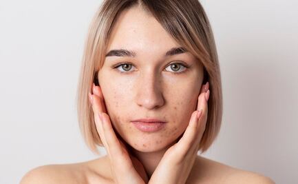 Cómo eliminar las cicatrices de acné de la cara