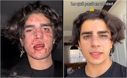 Con la cara golpeada, tiktoker denuncia agresión en bar de Querétaro