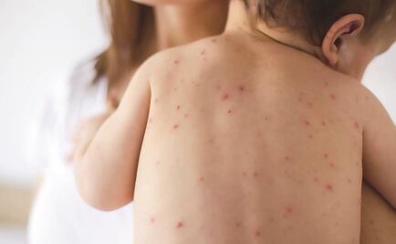 Prevé Ssa 2 o 3 decenas de casos importados de sarampión en 2019