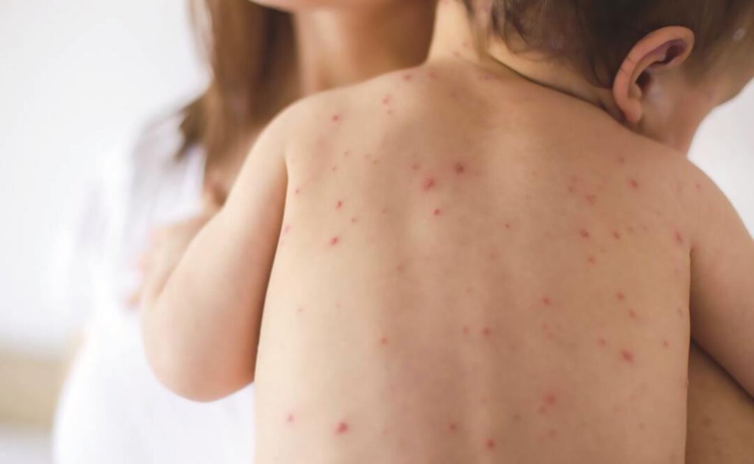 Prevé Ssa 2 o 3 decenas de casos importados de sarampión en 2019