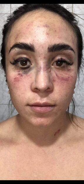 Mujer embarazada pide justicia tras sufrir golpiza por sobrino de candidata de Tlaxcala