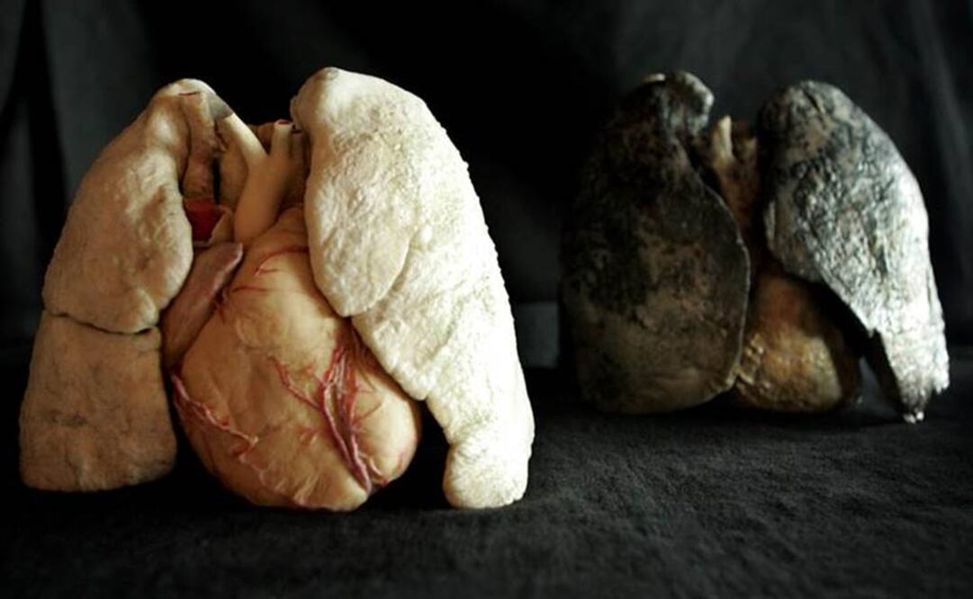 Entre 80 a 97% de los mexicanos con esta enfermedad mueren el mismo año en que fueron diagnosticados. Foto: Archivo