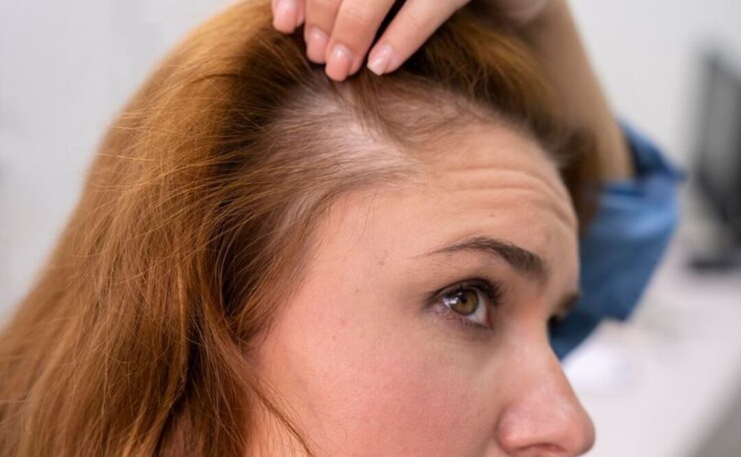 Alimentación contra la alopecia. Fuente: Freepik