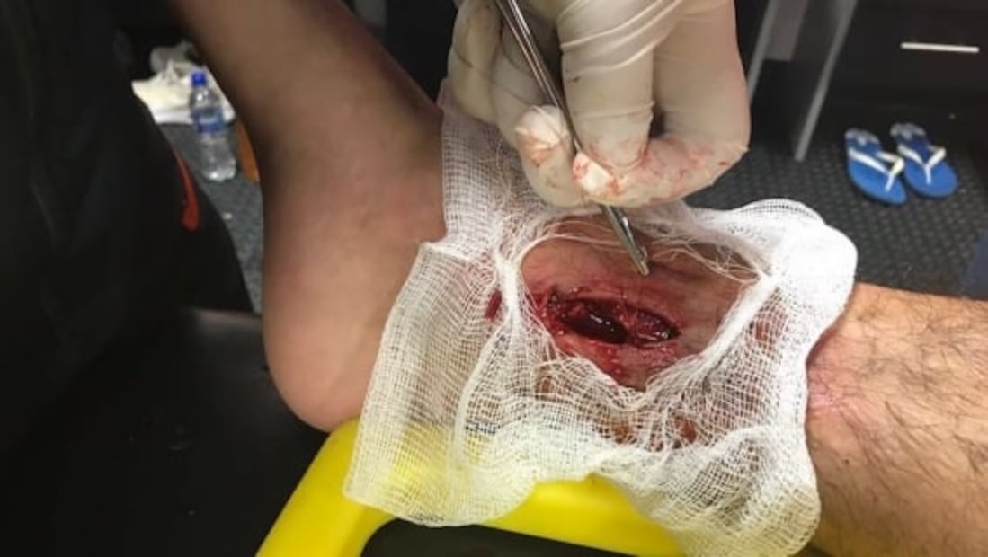 Las peores heridas por arteras entradas en el futbol