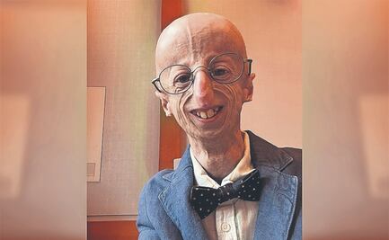 Pronto se podría tratar la progeria con edición génica