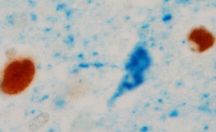 Buscan método para diagnóstico temprano del Alzheimer