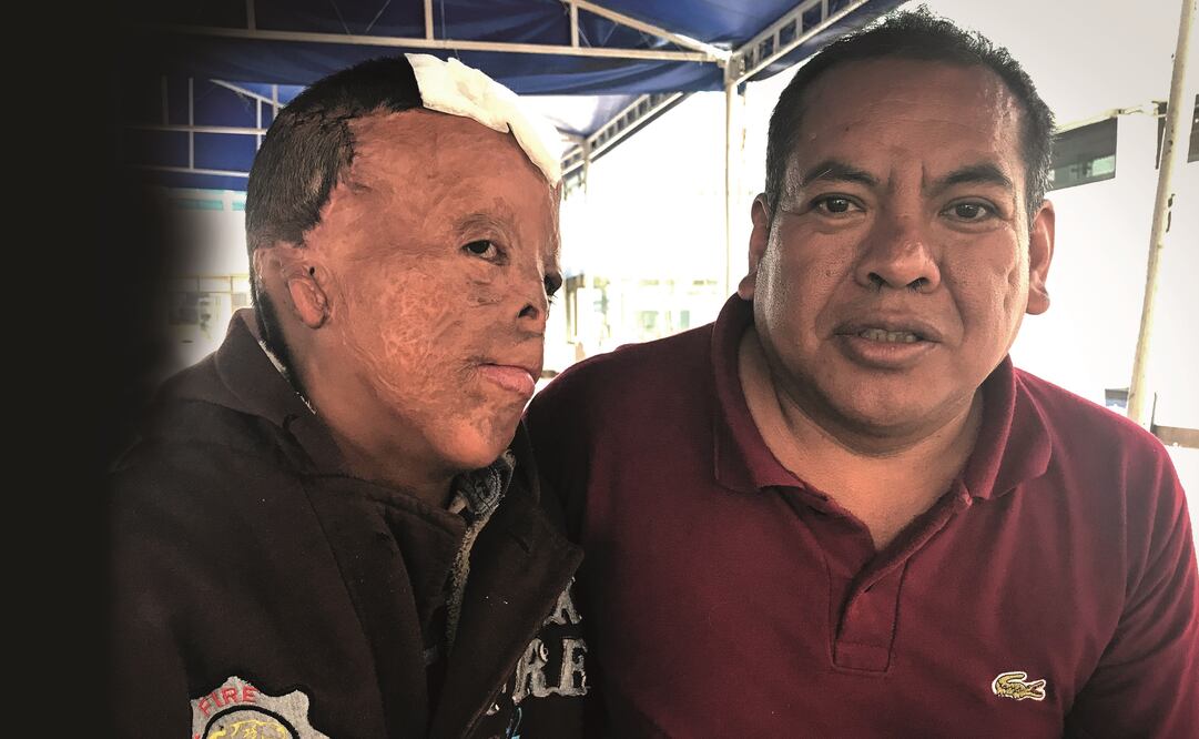 Los diversos traslados al hospital y los cuidados del niño, debido a la serie de cirugías que le realizan para que recupere su cabello, le impiden a Carlos Suárez tener un empleo formal. (REBECA JIMÉNEZ. EL UNIVERSAL)