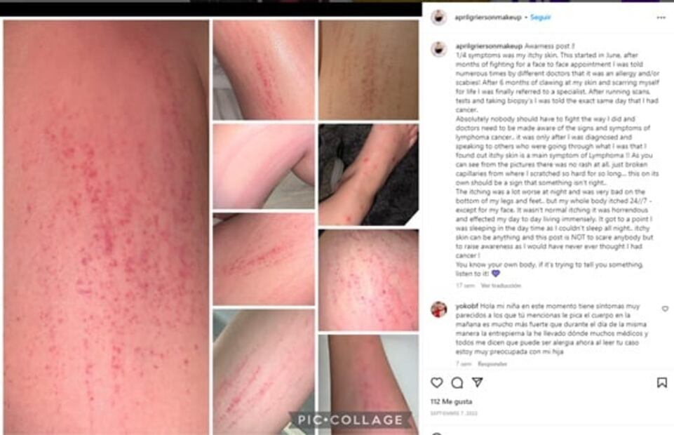 Va al médico por una picazón y le detectan cáncer