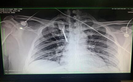 "Estoy vivo por un milagro", asaltantes clavan desarmador en el pecho a médico de Monterrey