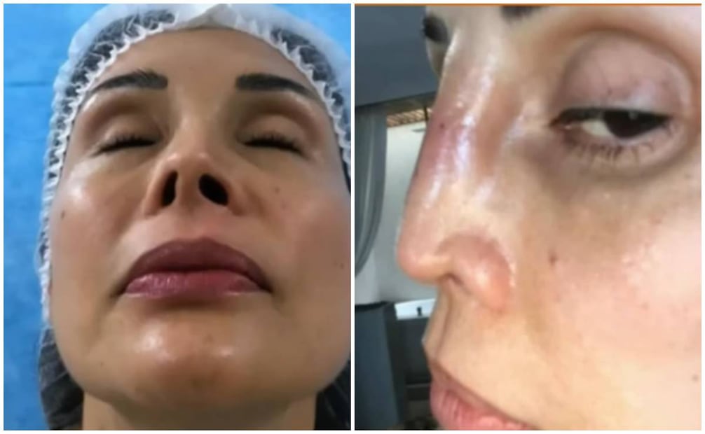 Tania Vázquez se sometió a una cirugía para que le corrigieran un pequeño problema, pero terminó con mutilación nasal.