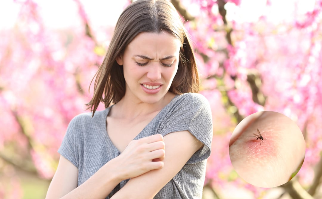 Las picaduras de insectos, especialmente las de mosquitos, pueden causar una incómoda comezón debido a la reacción del cuerpo ante la saliva del insecto. Foto: El Universal
