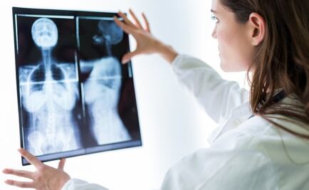 Qué es el cáncer de mama metastásico y cómo reconocer sus síntomas