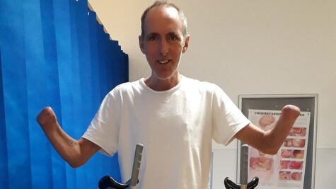 Por qué pedí que me amputaran las manos y las piernas