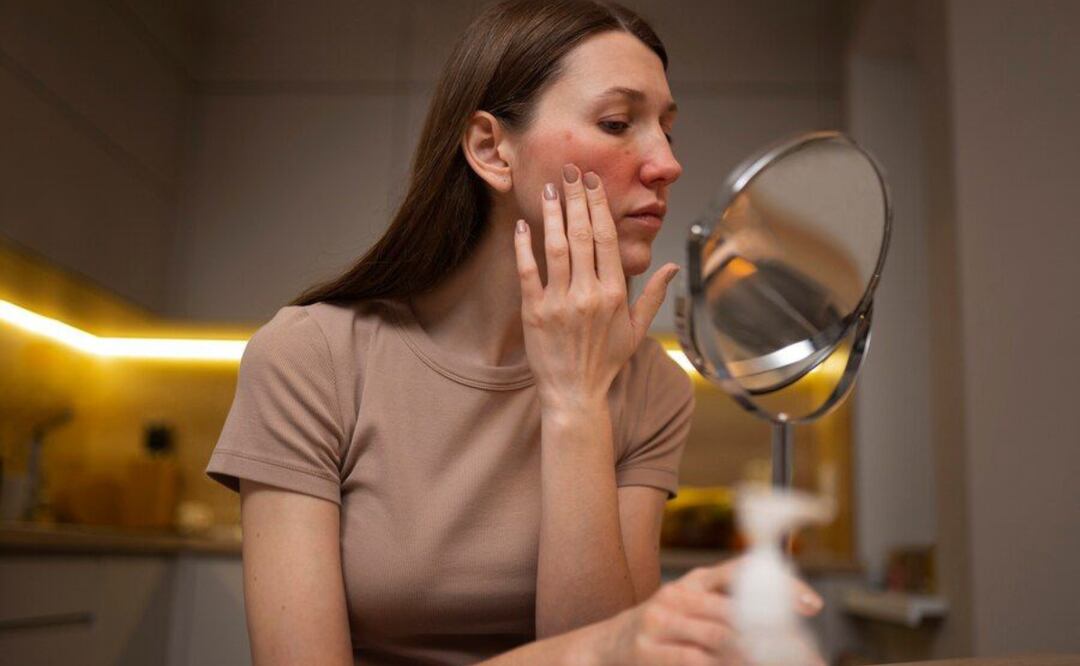 Desmitificando el acné en la adultez. Fuente: Freepik.