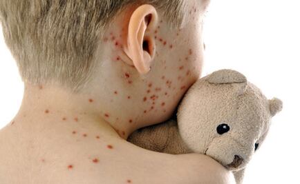 Cómo el sarampión destruye la memoria de tu sistema inmunitario