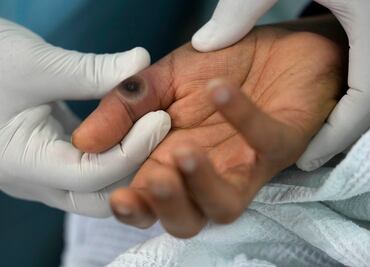 Texas registra la primera muerte en Estados Unidos por viruela del mono