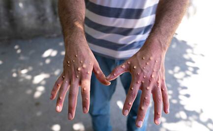 Secretaría de Salud confirma 788 casos de viruela del mono en México 