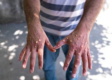 Secretaría de Salud confirma 788 casos de viruela del mono en México