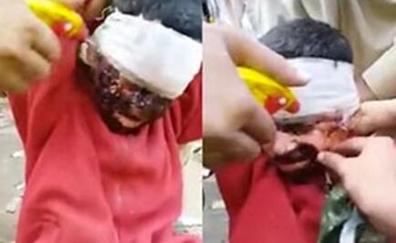 El Foco: Niño finge tener quemaduras para pedir dinero