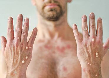 PRI exige a Secretaría de Salud vacunas para la comunidad LGBT+ contra la viruela símica