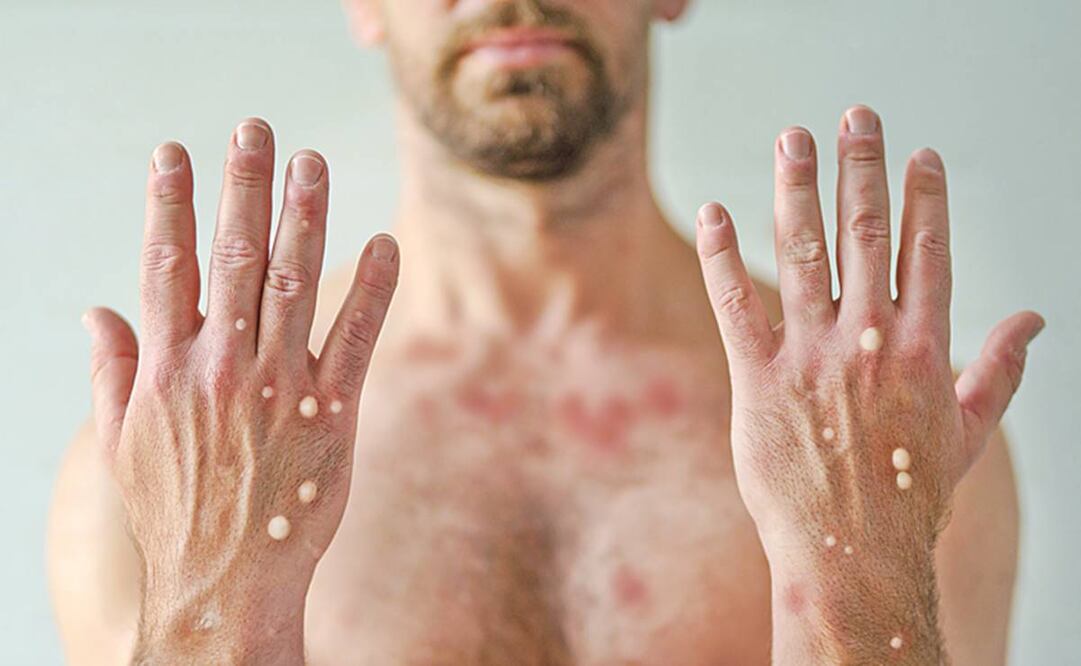 Las lesiones suelen aparecer más en la cara, las manos y los pies. Foto: ISTOCK