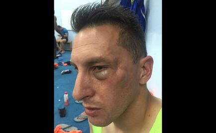 'Chaco', con fractura de pómulo