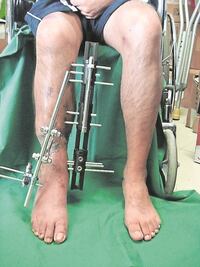 IMSS salva extremidad con innovadora técnica