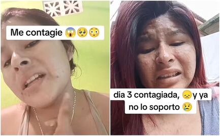 Joven mexicana confunde viruela del mono con varicela y se vuelve viral en TikTok