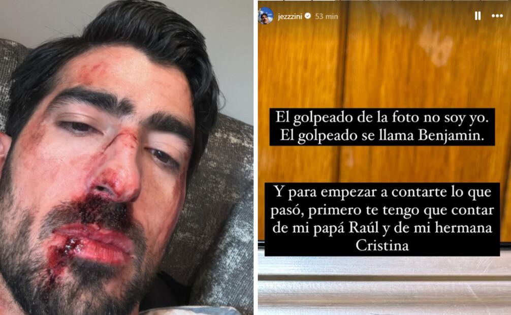 El creador de contenido desata especulaciones en redes sociales al mostrarse golpeado.
Foto: Caotura de pantalla en Instagram