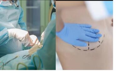 Mujer recibe disparo en el pecho y prótesis de silicona de sus senos le salvan la vida