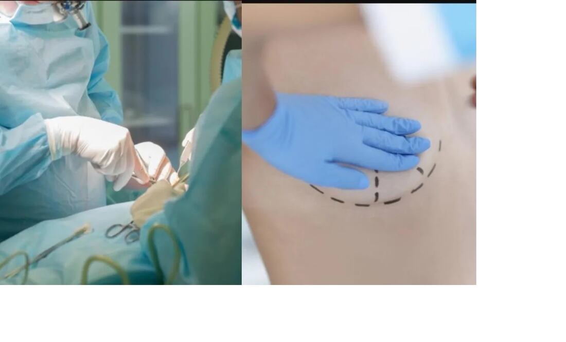 Una mujer recibió un disparo. Sus prótesis de silicona le salvaron la vida. FOTO: ESPECIAL