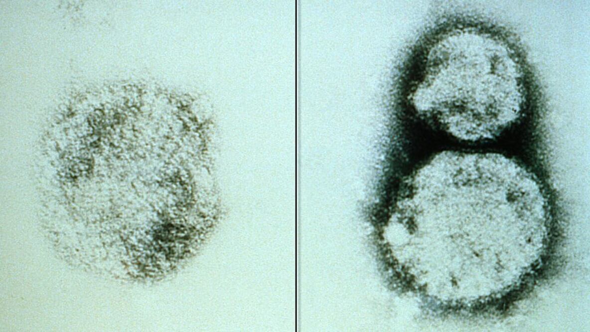 Hantavirus: cuáles son los síntomas de esta enfermedad