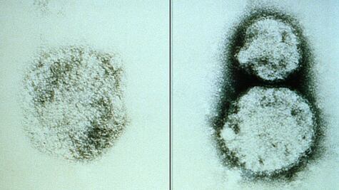 Hantavirus: cuáles son los síntomas de esta enfermedad