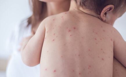 Condado de Nueva York declara segundo estado de emergencia por sarampión