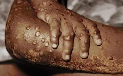 "Es el mayor brote jamás visto en Europa": la viruela de mono es detectada en más de 10 países