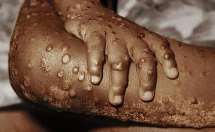 "Es el mayor brote jamás visto en Europa": la viruela de mono es detectada en más de 10 países