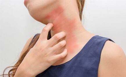 El 20% de la población en México padece alguna alergia